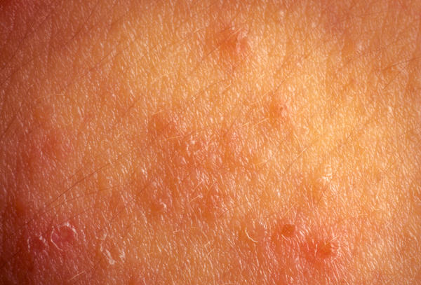 eczema on the vulva Eczema on the vulva